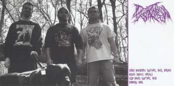 CD Dyskinesia: Micturating Deposits Of Grit Through The Urinary Tract